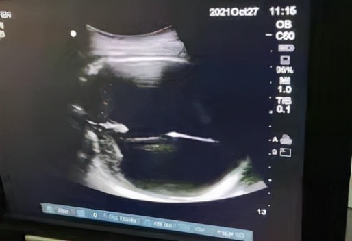 省婦幼保健院產科成功為重度腦積水胎兒行胎兒顱骨穿刺腦脊液抽吸術 省婦幼保健院產科成功為重度腦積水胎兒行胎兒顱骨穿刺腦脊液抽吸術