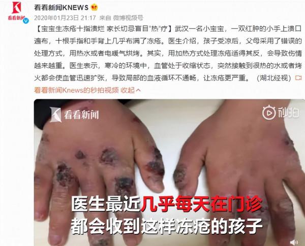 好疼!家長盲目取暖,寶寶十指潰爛:冬季護理切記這3點 好疼!家長盲目取暖,寶寶十指潰爛:冬季護理切記這3點