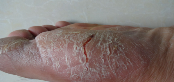 冬季手足紅斑乾裂 是溼疹還是凍瘡？1分鐘辨別，對症治療才有效
