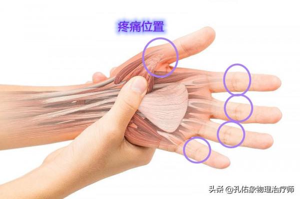 手指發脹、僵硬、握不攏，是風溼嗎？不出意外，這4種可能性較大