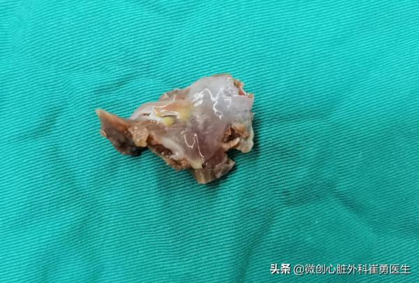 無可見疤痕的微創肥厚梗阻性心肌病手術 無可見疤痕的微創肥厚梗阻性心肌病手術