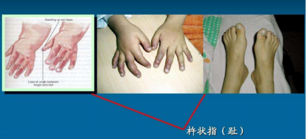 癌症早期會不會有先兆？醫生：實不相瞞，身體有這5個表現要警惕