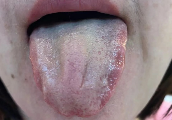 體內有痰還有淤，痰瘀互結怎麼辦？兩味中藥，健脾化痰、通絡除淤