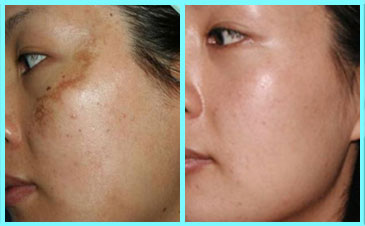 如何從根源上解決黃褐斑問題? 如何從根源上解決黃褐斑問題?