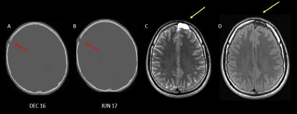 頭皮和顱骨病變的影像學特點 頭皮和顱骨病變的影像學特點