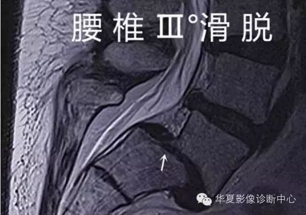 骶椎腰化/腰椎骶化、腰椎滑脫、腰肌勞損，簡單易懂圖解