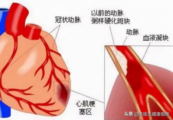 瑞舒伐他汀3大功效,該吃的人沒有吃,3年後冠脈造影結果大不同 瑞舒伐他汀3大功效,該吃的人沒有吃,3年後冠脈造影結果大不同