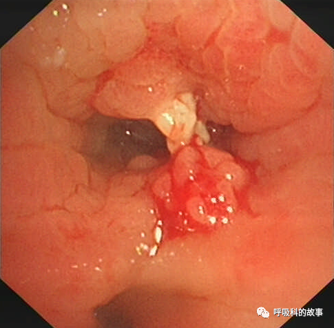 咳嗽半年反覆肺炎為什麼治不好 細看影像發現端倪緣是異物堵塞