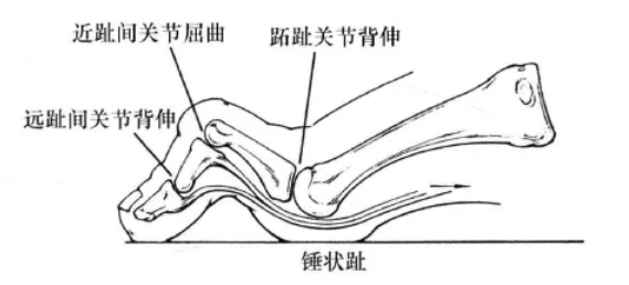 腳趾彎曲像&OpenCurlyDoubleQuote;錘子&rdquo;？警惕可能是錘狀趾