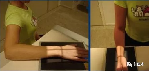 贊！腕關節X線高畫質解剖+腕骨脫位典型病例