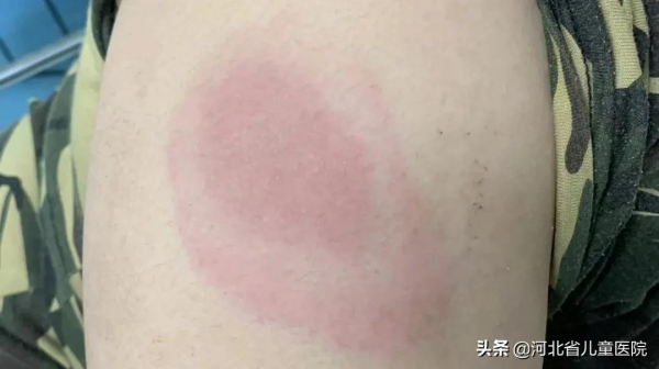 同行們看過來，注射維生素K1有可能過敏！