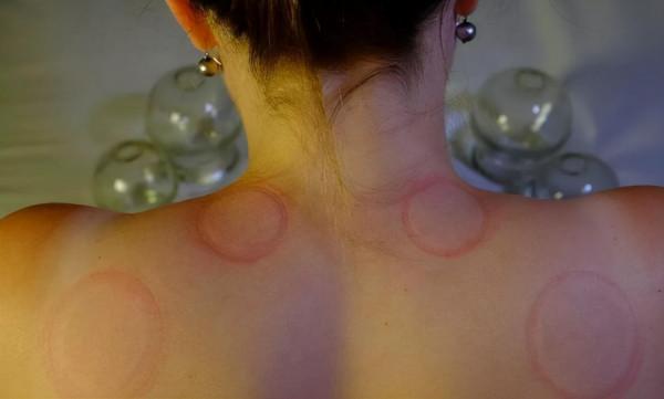 拔火罐時,後背吸出來的瘀血,真的是毒素嗎?醫生告訴你實話 拔火罐時,後背吸出來的瘀血,真的是毒素嗎?醫生告訴你實話