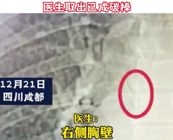 家有小孩要警惕!四川女子右胸藏針30年不自知,醫生取出已成碳棒 家有小孩要警惕!四川女子右胸藏針30年不自知,醫生取出已成碳棒