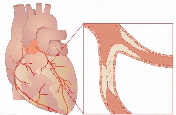2箇中成藥，益氣強心、活血化瘀、通絡止痛，抗冠心病恢復心功能