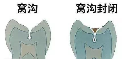 該如何做才能保護好寶寶的牙齒 該如何做才能保護好寶寶的牙齒