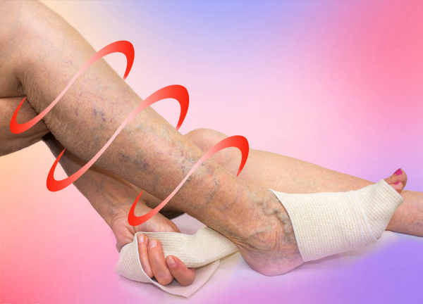 靜脈炎，疼痛腫脹、伴有條索狀？一藥溶血栓、疏通脈絡、抗炎鎮痛