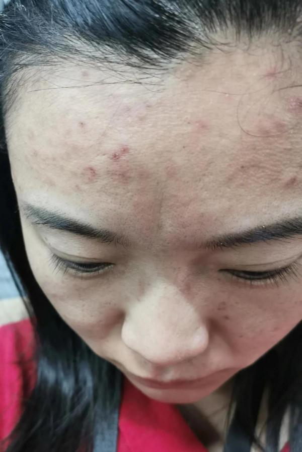 吐血三年“戰痘”，停止在臉上折騰以後，面板再也沒長過痘