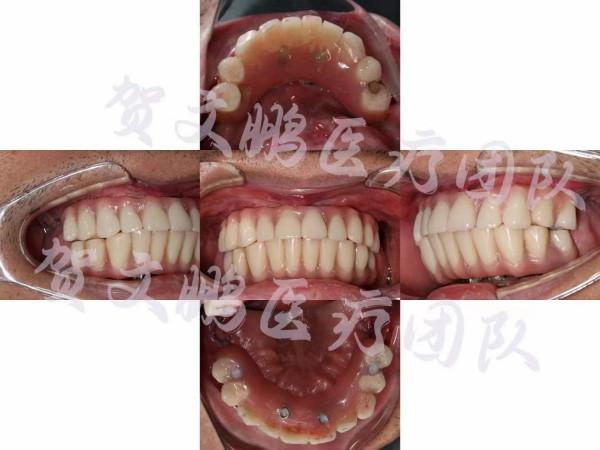 牙齒掉光還有高血壓？精確種牙即刻恢復咀嚼功能