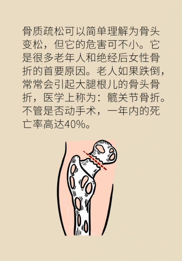 骨質疏鬆危害大!專家教你如何科學補鈣 骨質疏鬆危害大!專家教你如何科學補鈣