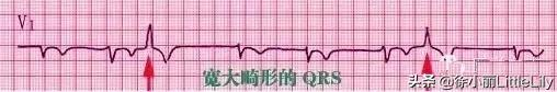 這樣教你看心電圖,沒有理由看不懂 這樣教你看心電圖,沒有理由看不懂