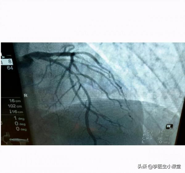 闢謠！冠心病好轉後就不用吃藥了嗎？有多少人因此放了心臟支架