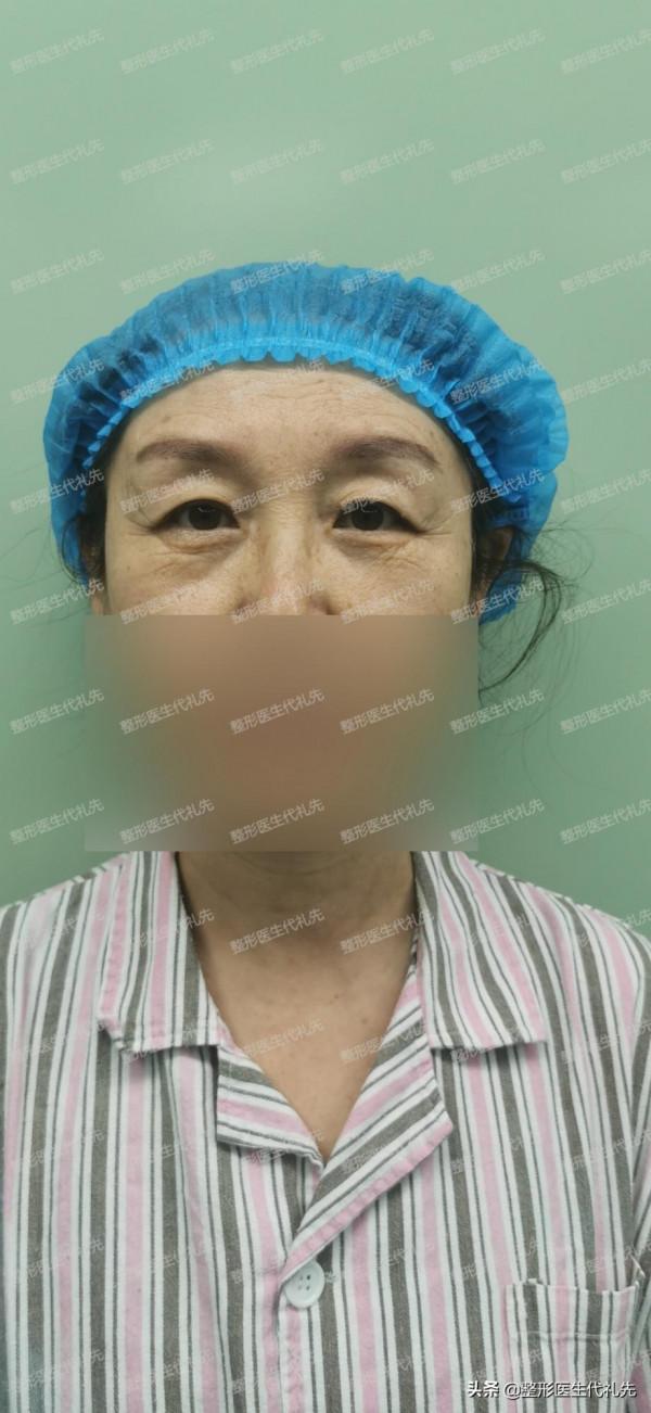 57歲眼周年輕化手術術前術後對比，公開6點細節感受