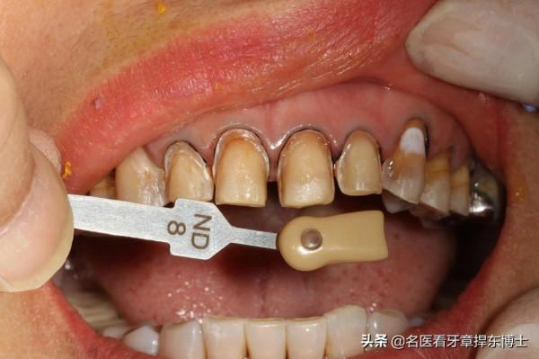 美麗前牙再煥發青春