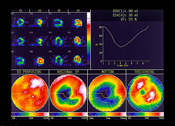 2個成藥，益氣溫腎強心、利水消腫、抑制心臟擴大，抗冠心病心衰