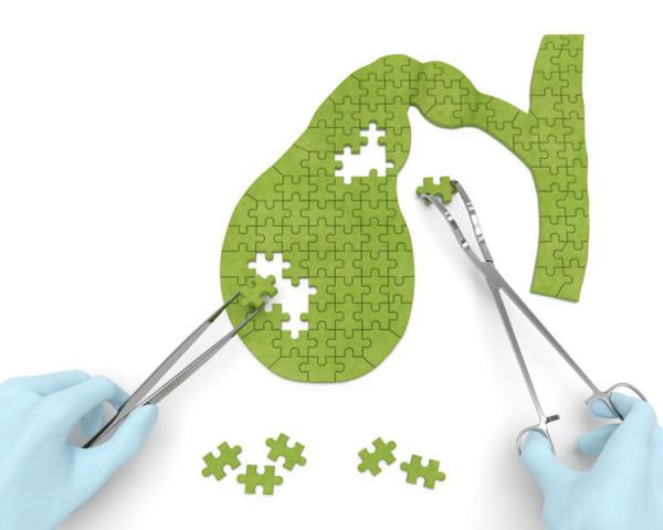 男子一天吃4個雞蛋膽囊內長滿結石，吃雞蛋真的會導致膽結石嗎？