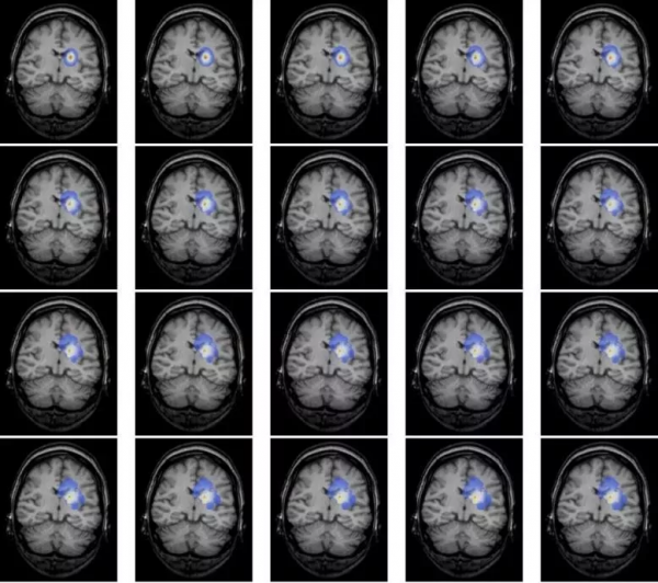 歐美四大神外中心聯合研究揭示：早期手術對低級別膠質瘤的益處