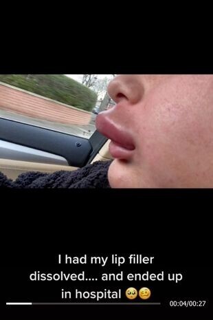 女子因溶解嘴部填充物導致嚴重過敏變成“辛普森” 女子因溶解嘴部填充物導致嚴重過敏變成“辛普森”