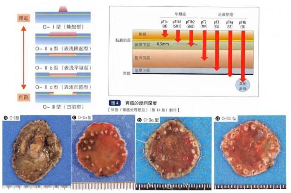 早期胃癌病理診斷：WHO VS.日本標準一文解析