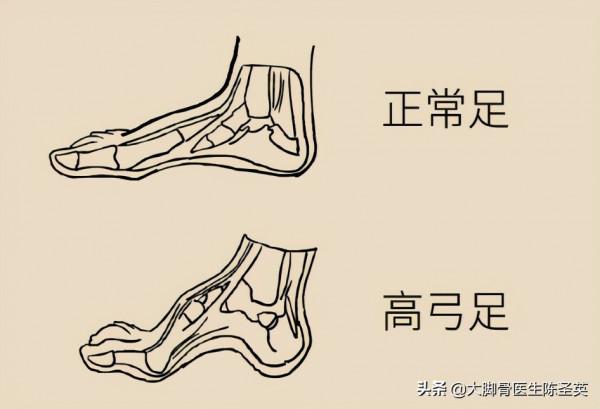 腳底板愛長繭子,走路疼痛到底是怎麼回事? 腳底板愛長繭子,走路疼痛到底是怎麼回事?