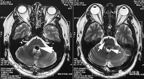 一例腦幹海綿狀血管瘤的手術陷阱