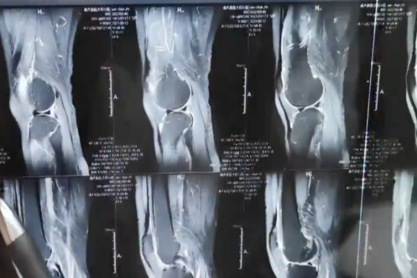 老年人經常蹲著幹活,膝蓋會變成啥樣?3件事會傷膝蓋,最好別做 老年人經常蹲著幹活,膝蓋會變成啥樣?3件事會傷膝蓋,最好別做
