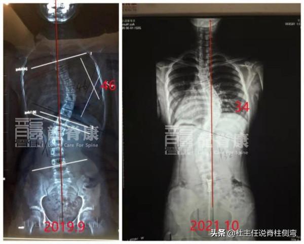 超過40度的脊柱側彎，是手術還是保守治療？