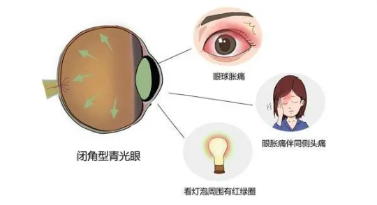 「眼病預警」當眼睛出現這些症狀，要注意了