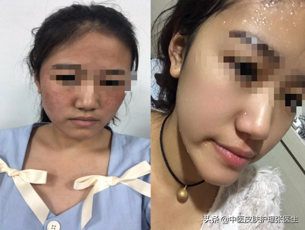 中醫分型論治黃褐斑，從此不再做“黃臉婆”