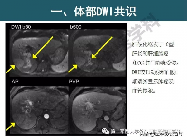 體部DWI共識及胰腺DWI研究經驗介紹