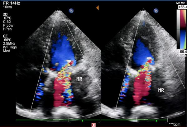 中秋假期,老人心臟生物瓣膜衰敗生命垂危,多學科團隊新技術成功巧換“心門” 中秋假期,老人心臟生物瓣膜衰敗生命垂危,多學科團隊新技術成功巧換“心門”