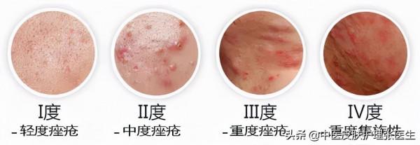 青春已走遠,青春痘還在,痘痘到底該如何治療? 青春已走遠,青春痘還在,痘痘到底該如何治療?