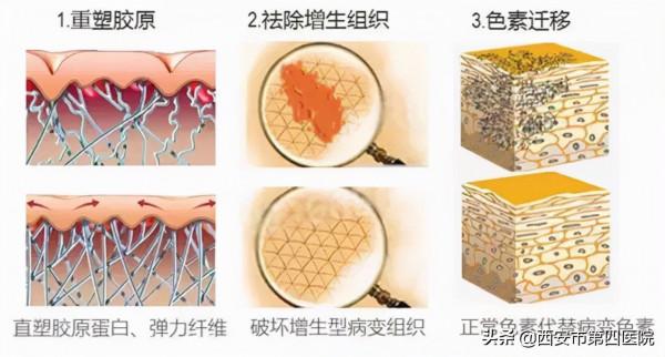 #安心變美課堂##我的安心變美推薦# 鐳射祛疤,這些事項你瞭解嗎??? #安心變美課堂##我的安心變美推薦# 鐳射祛疤,這些事項你瞭解嗎???