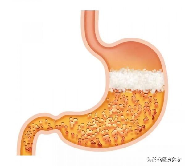 腹痛、腹脹，可能是消化性潰瘍！“三分治，七分養”調理好胃腸
