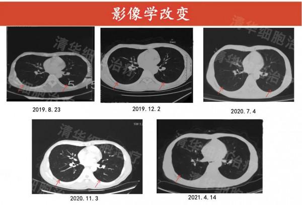 有效抑制癌症復發轉移，新案例證明：細胞免疫治療這點強