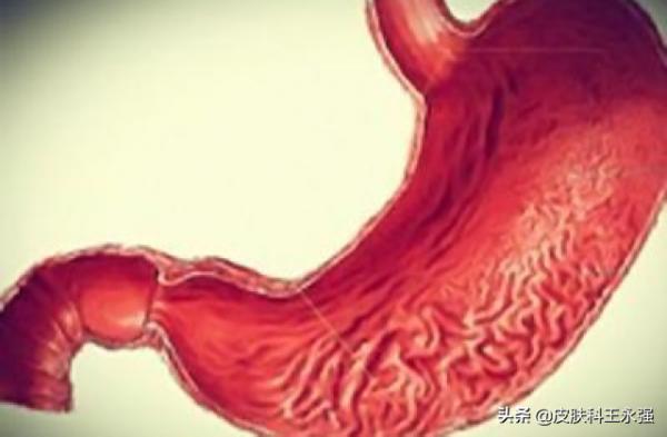 老胃病消瘦貧血,萎縮性胃炎,學會吃飯和吃藥同樣重要 老胃病消瘦貧血,萎縮性胃炎,學會吃飯和吃藥同樣重要