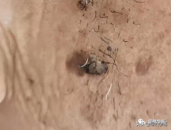 面板黑痣發展破潰形成的可疑面板惡性腫瘤 面板黑痣發展破潰形成的可疑面板惡性腫瘤