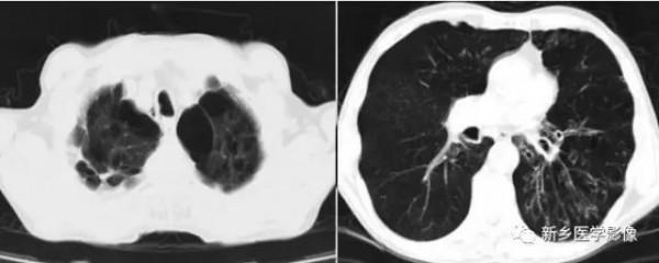 肺部5大基本病變,影像診斷的基礎 肺部5大基本病變,影像診斷的基礎