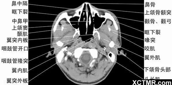 頭頸五官CT斷層解剖圖及常見病影像診斷