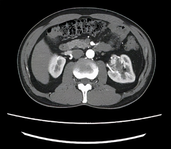 步入中年,體檢卻發現左腎上長了一顆“定時炸彈” 步入中年,體檢卻發現左腎上長了一顆“定時炸彈”