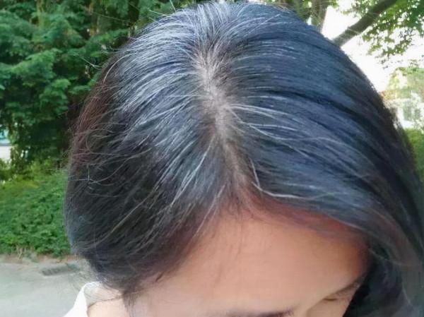 為什麼白頭髮越長越多？你以為是老了，醫生：或是缺乏2種營養素